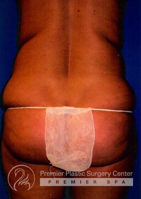 Liposuction Before & After Image