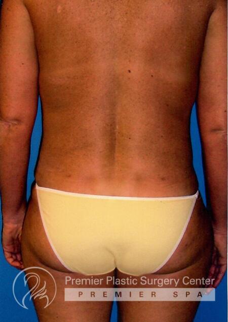 Liposuction Before & After Image