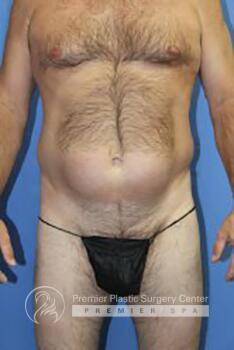 Liposuction For Men Before & After Image