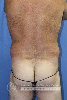 Liposuction For Men Before & After Image