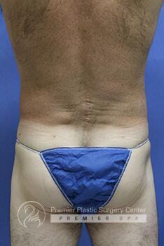 Liposuction For Men Before & After Image