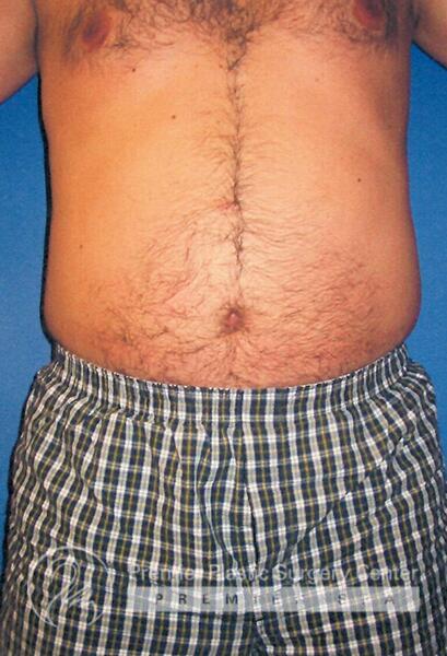 Liposuction For Men Before & After Image