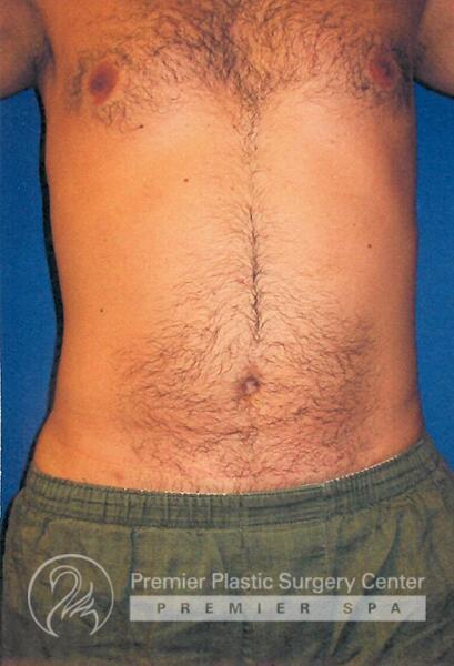 Liposuction For Men Before & After Image