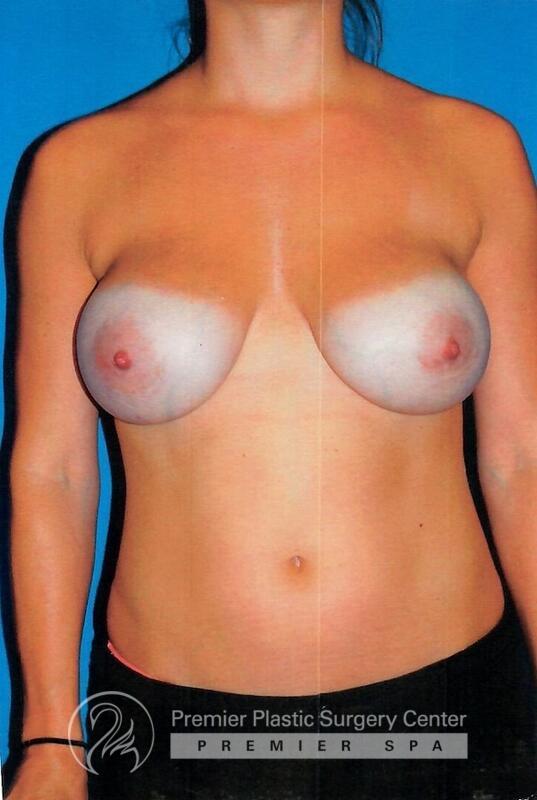 Breast Implant Revision Before & After Image