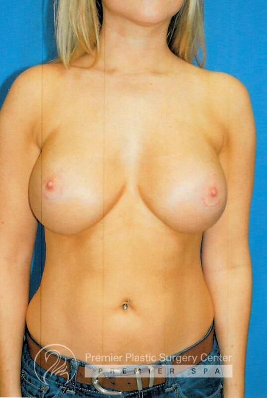 Breast Implant Revision Before & After Image