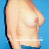 Breast Implant Revision Before & After Image