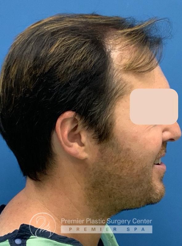 Neograft Hair Transplant Before & After Image