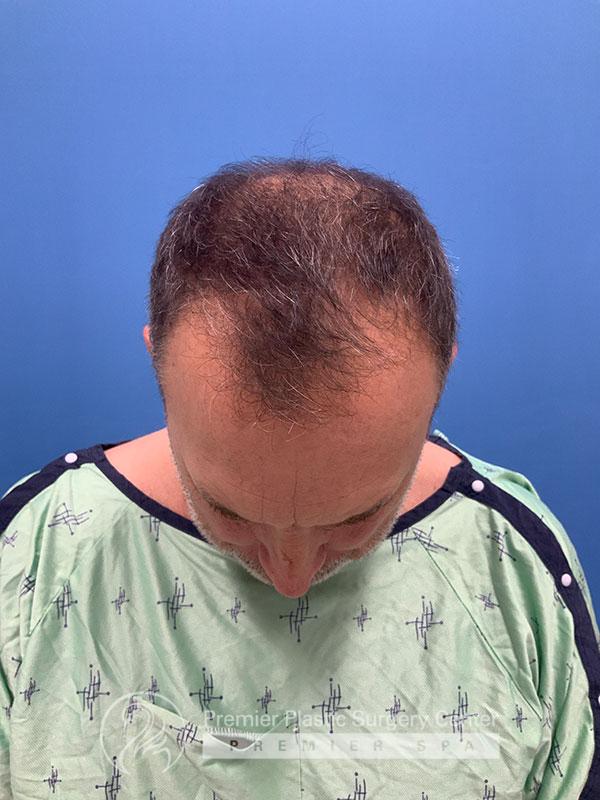 Neograft Hair Transplant Before & After Image