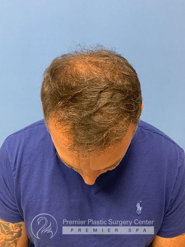 Neograft Hair Transplant Before & After Image