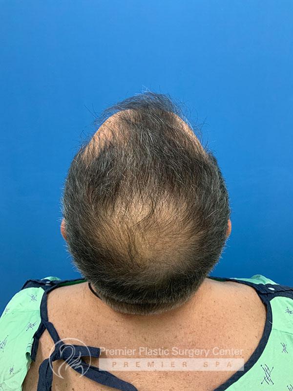 Neograft Hair Transplant Before & After Image