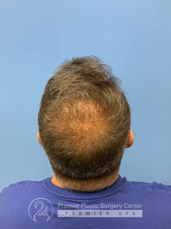 Neograft Hair Transplant Before & After Image