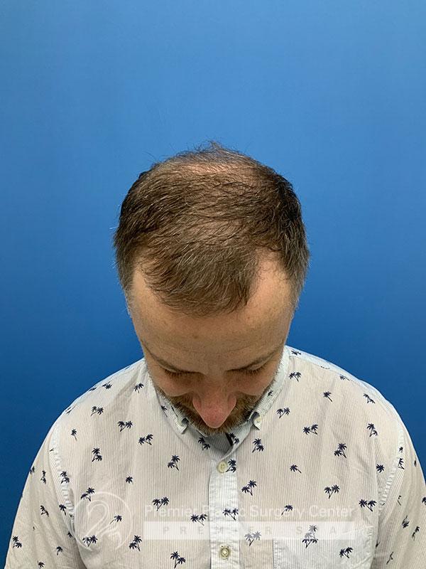 Neograft Hair Transplant Before & After Image