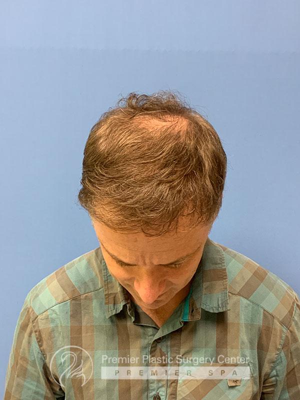 Neograft Hair Transplant Before & After Image