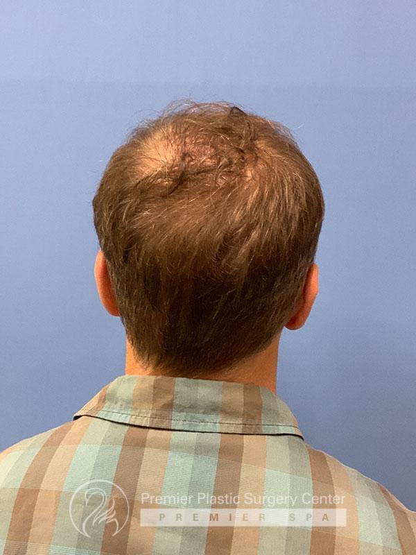 Neograft Hair Transplant Before & After Image