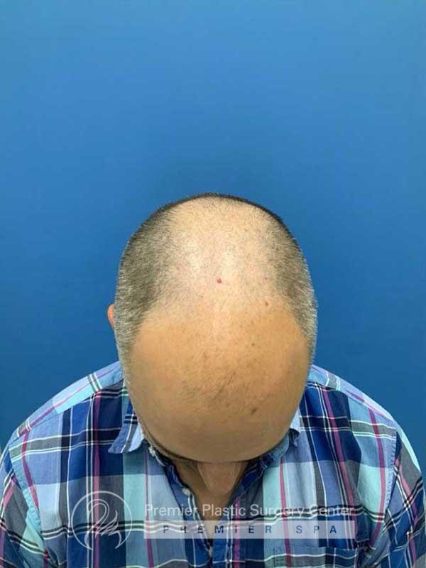 Neograft Hair Transplant Before & After Image