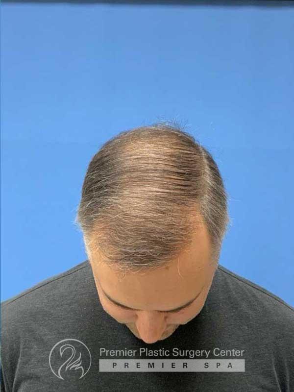 Neograft Hair Transplant Before & After Image