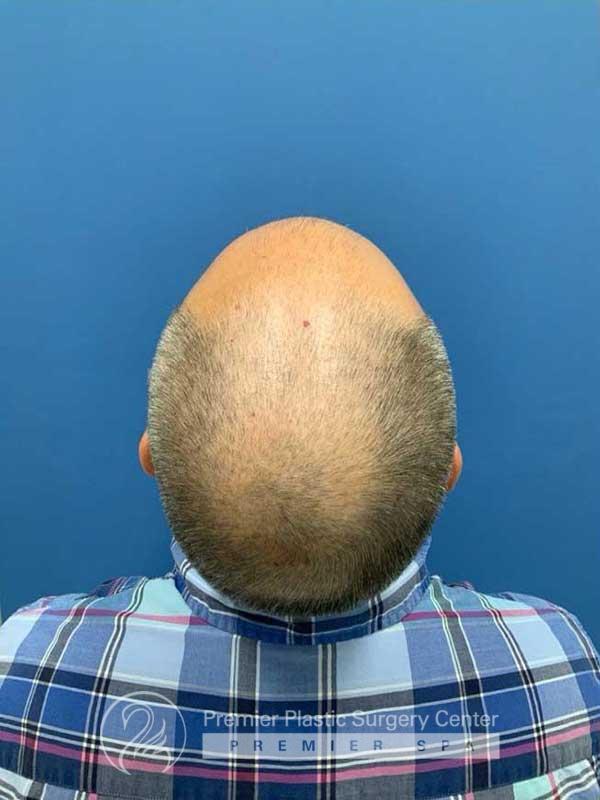 Neograft Hair Transplant Before & After Image