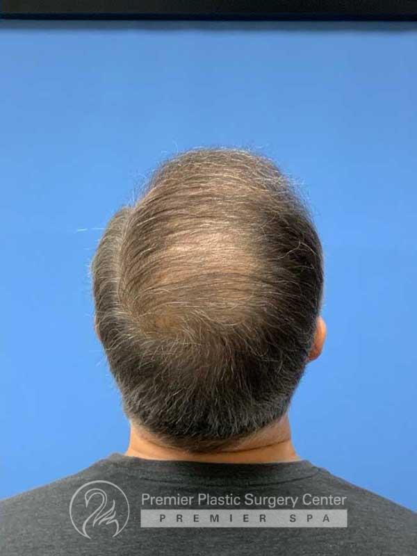 Neograft Hair Transplant Before & After Image