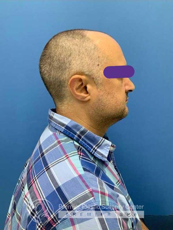 Neograft Hair Transplant Before & After Image