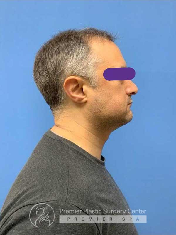 Neograft Hair Transplant Before & After Image